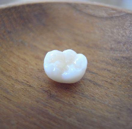 tooth20140624.jpg